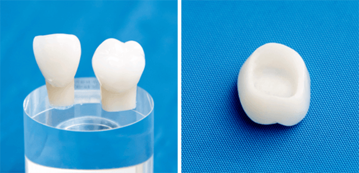 インプラント費用1歯35万円（税込38万5000円）