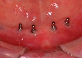 義歯の維持装置ためのインプラントを4本埋入した状態