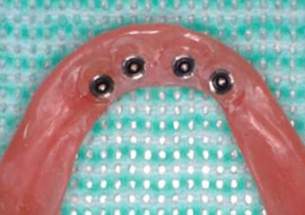 義歯の維持装置