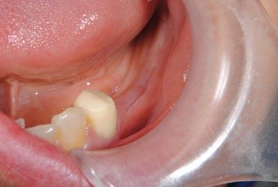 骨移植による骨造成について