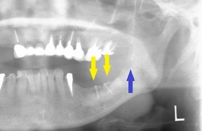 骨移植による骨造成について
