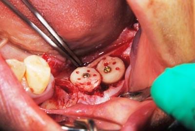 骨移植による骨造成について