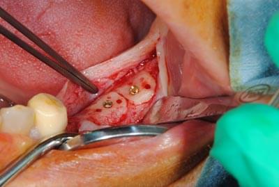 骨移植による骨造成について