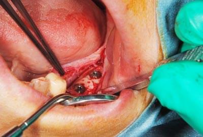 骨移植による骨造成について