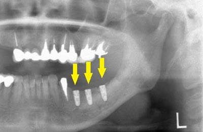 骨移植による骨造成について