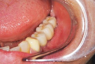 骨移植による骨造成について