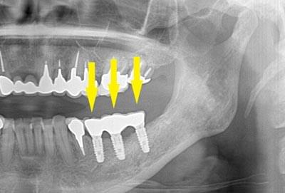 骨移植による骨造成について