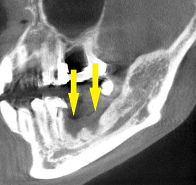 骨移植による骨造成について2