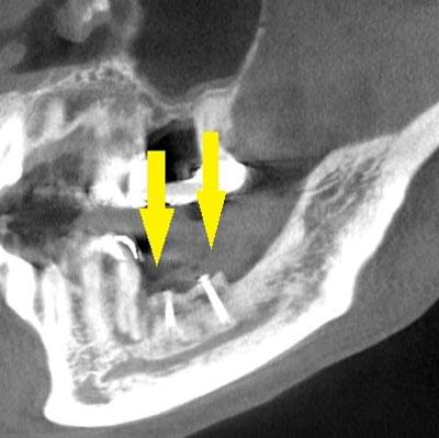骨移植による骨造成について2