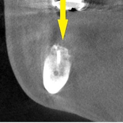 骨移植による骨造成について2