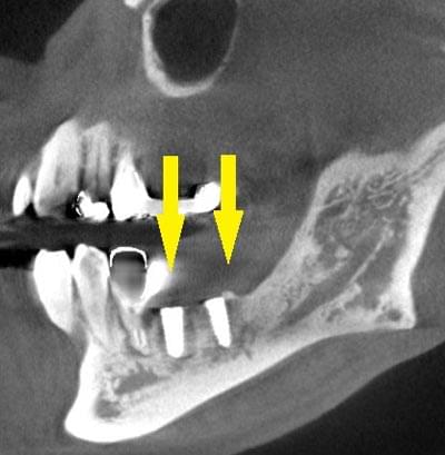 骨移植による骨造成について2