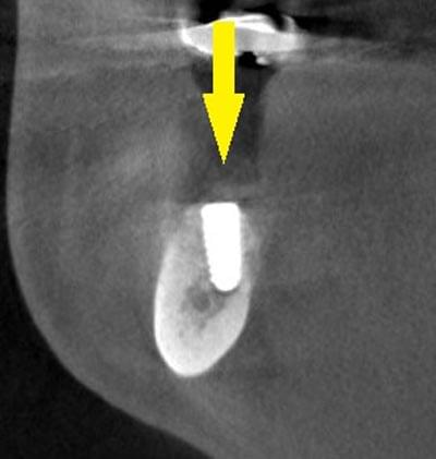骨移植による骨造成について2