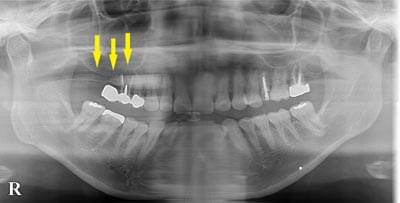 サイナスリフトによる骨造成について