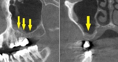 サイナスリフトによる骨造成について