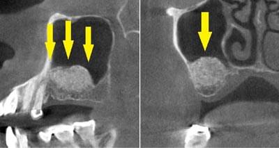 サイナスリフトによる骨造成について