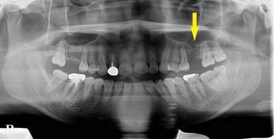 ソケットリフトによる骨造成について
