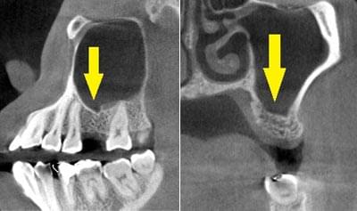ソケットリフトによる骨造成について