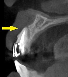 人工骨と自家骨、人工膜（メンブレン）による骨造成について