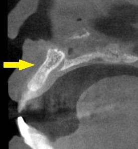人工骨と自家骨、人工膜（メンブレン）による骨造成について