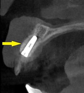 人工骨と自家骨、人工膜（メンブレン）による骨造成について