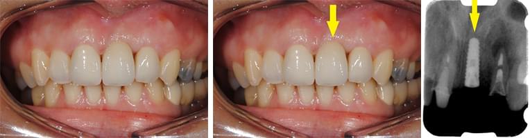 1歯35万円（税込38万5000円）のわけ