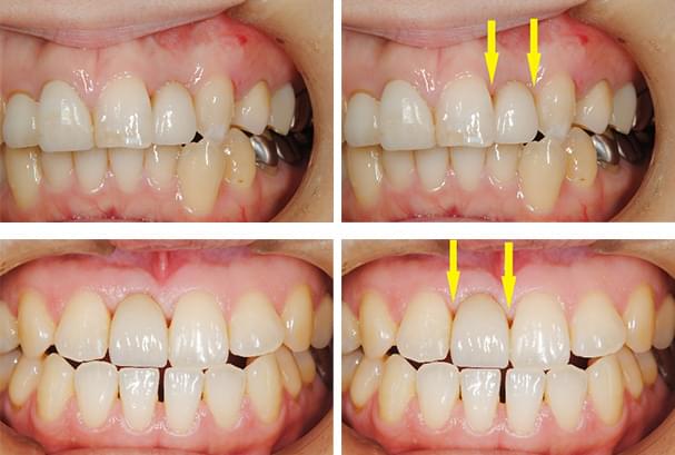 1歯35万円（税込38万5000円）のわけ