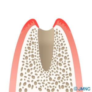 抜歯即時インプラント埋入術をイラストで解説