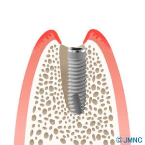 抜歯即時インプラント埋入術をイラストで解説