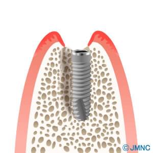 抜歯即時インプラント埋入術をイラストで解説